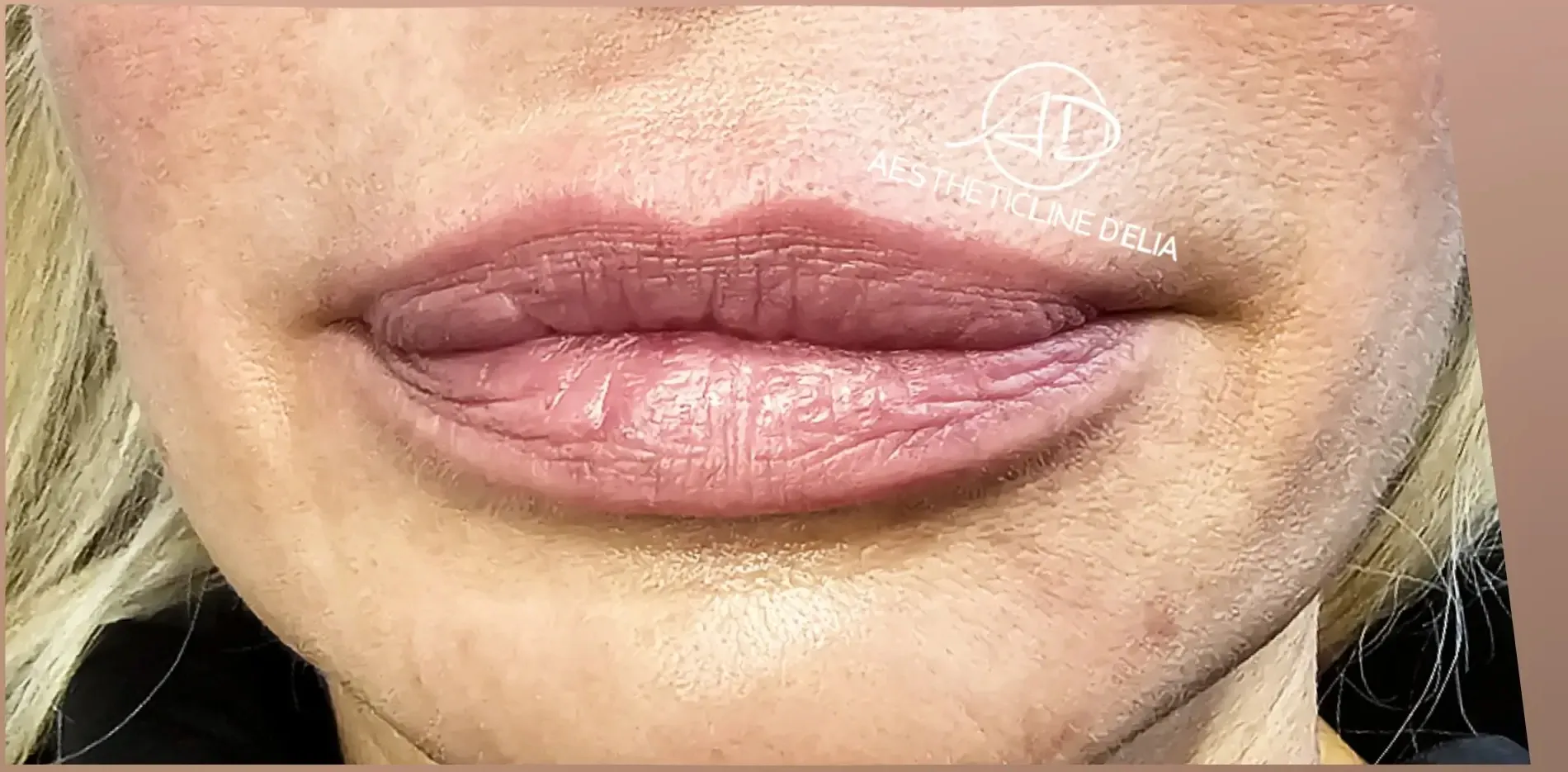 Lippen 2 nachher