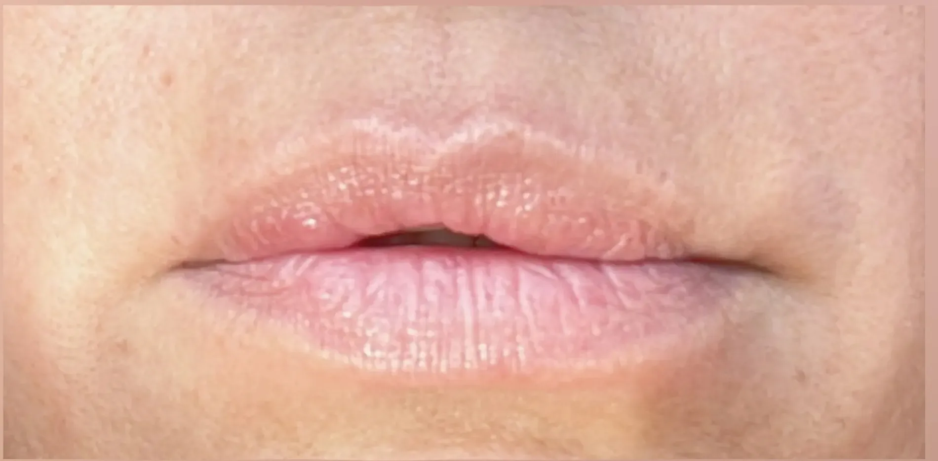 Lippen 2 vorher