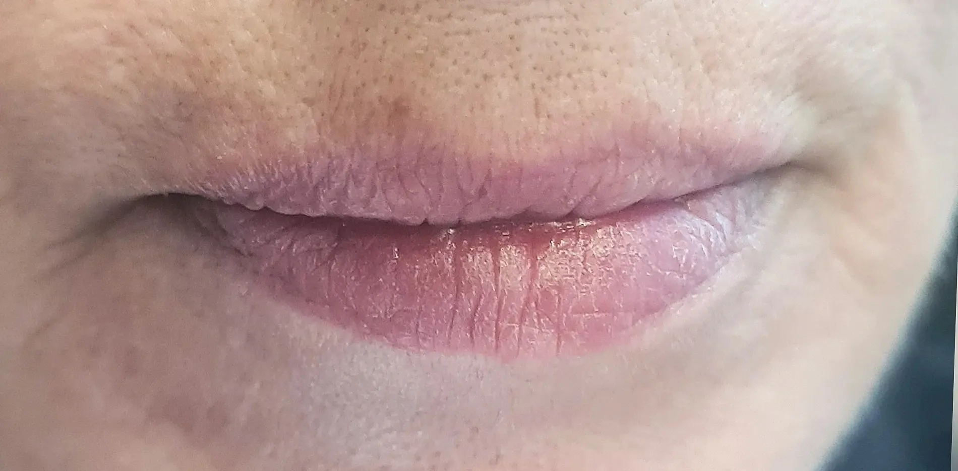 Lippen 3 vorher