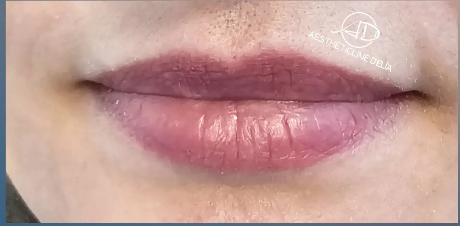 Lippen 4 nachher