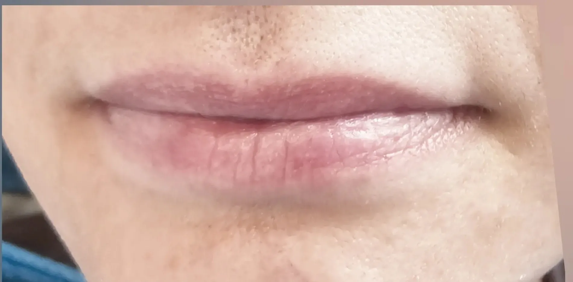 Lippen 4 vorher