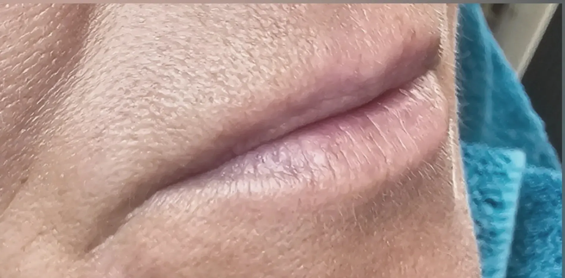 Lippen 5 vorher