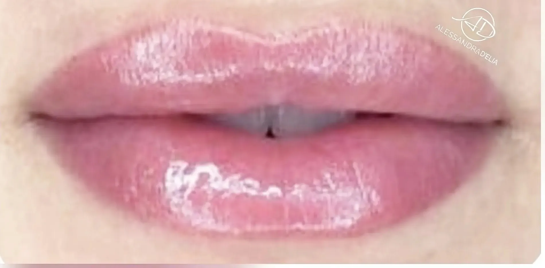 Lippen 6 nachher