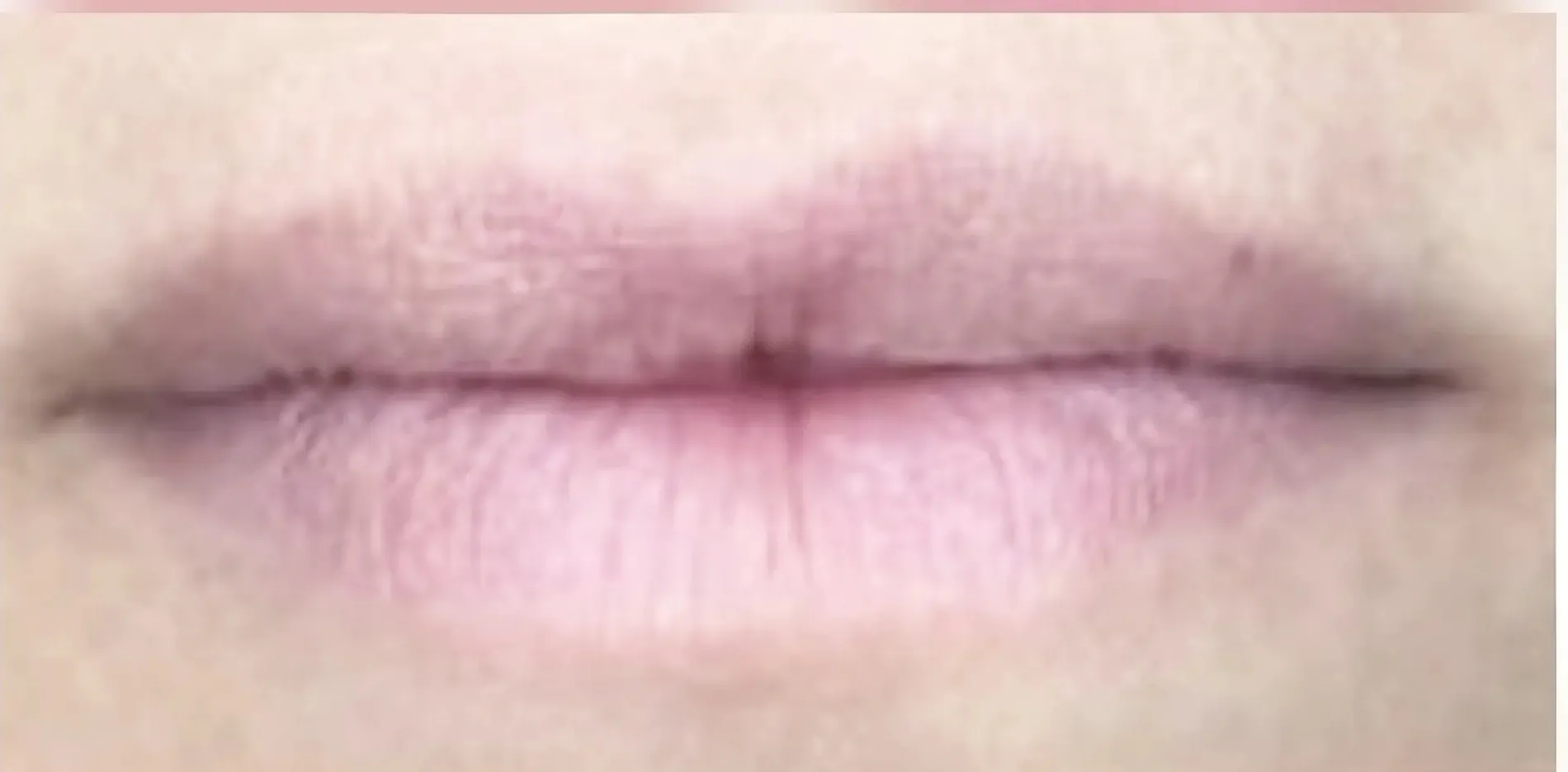 Lippen 6 vorher