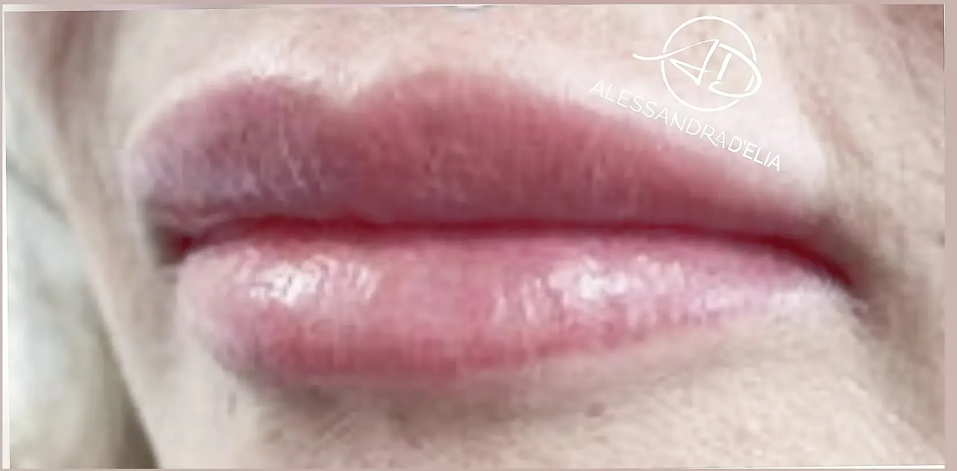 Lippen 7 nachher